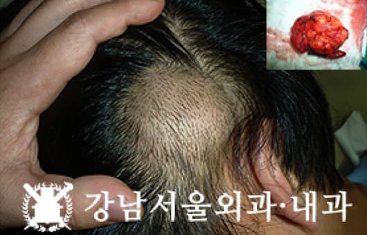 CASE 01 30세 남성 거대지방