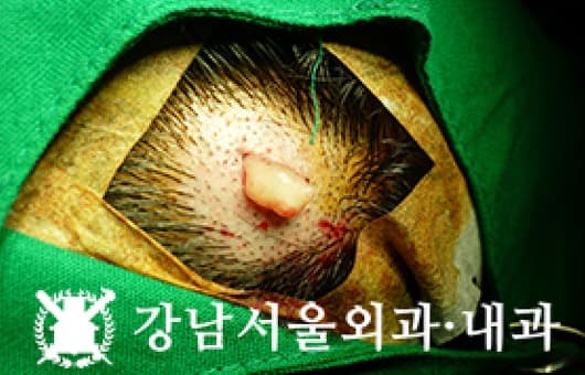 CASE 02 37세 여성 신경섬유