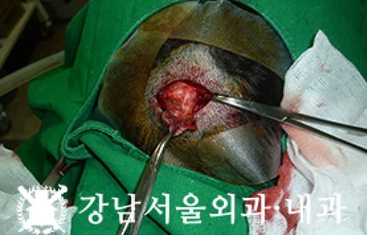 CASE 03 41세 남성 표피낭종