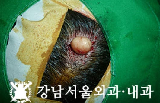 CASE 04 47세 남성 모낭낭종