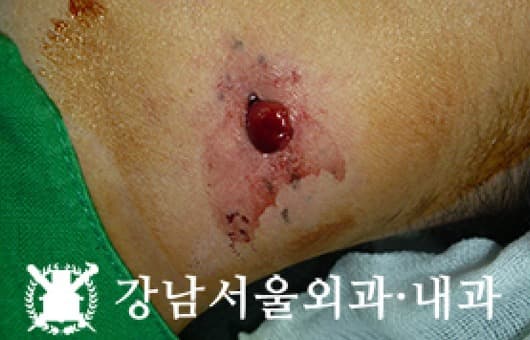 CASE 05 28세 남성 림프절종대