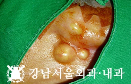 CASE 06 29세 남성 표피낭종