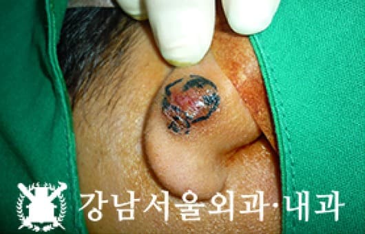 CASE 07 30세 남성 타병원 3회 수술 후 재발