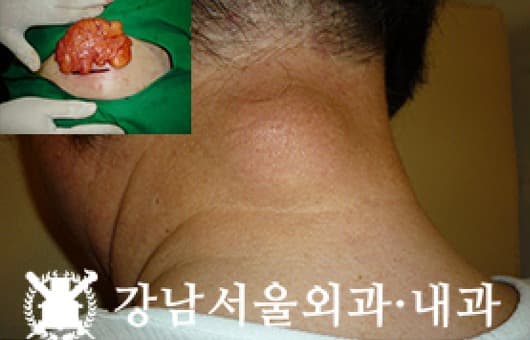 CASE 08 64세 남성 지방종