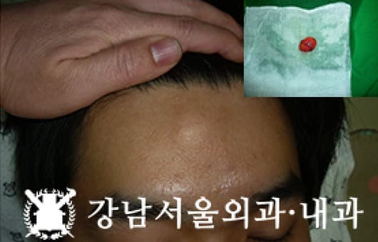 CASE 09 28세 남성 지방종