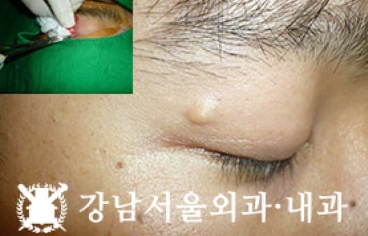 CASE 10 29세 남성 표피낭