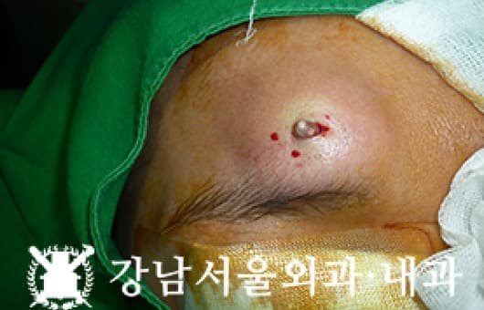 CASE 11 35세 여성 석회화 모기질종
