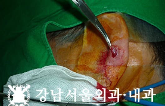 CASE 12 45세 남성 혈관평활근종