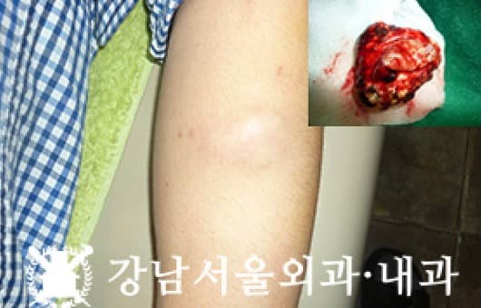 CASE 13 31세 남성 거대 모기질종