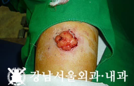 CASE 14 31세 남성 지방종