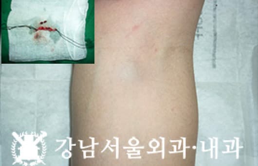 CASE 15 41세 남성 표피낭종