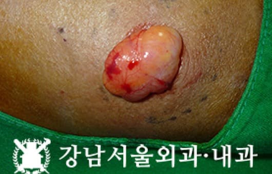 CASE 16 40세 남성 악성 지방육종