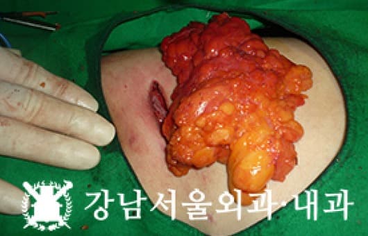 CASE 17 31세 여성 어깨 거대지방종