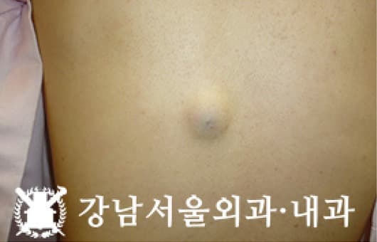 CASE 18 33세 여성 등 표피낭종