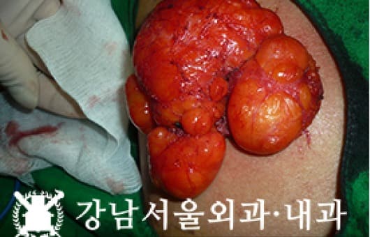 CASE 19 38세 남성 등 거대지방종