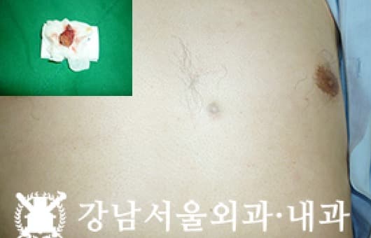 CASE 20 41세 남성 가슴 신경초종