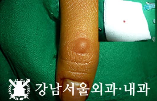 CASE 21 23세 여성 혈관종