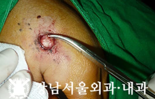 CASE 22 29세 남성 표피낭종