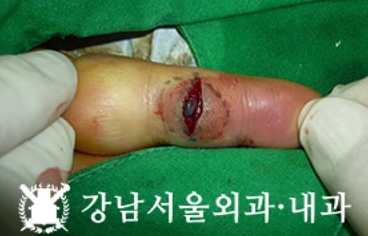 CASE 23 42세 여성 정맥성 혈관류