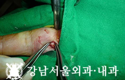CASE 24 43세 남성 결절종