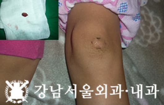 CASE 25 7세 여아 혈관종