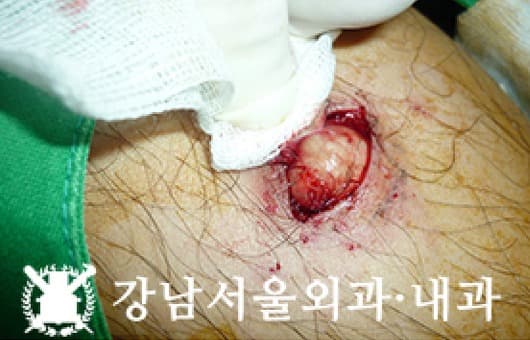 CASE 26 28세 남성 표피낭종