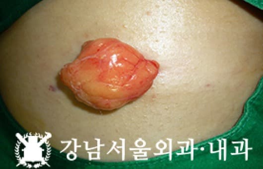 CASE 27 32세 여성 지방종