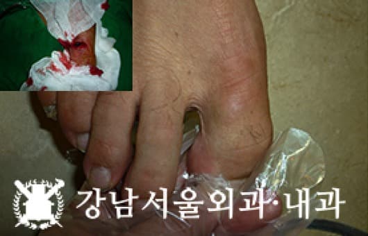CASE 28 28세 남성 정맥성 혈관류