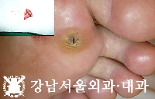 CASE 29 31세 남성 표피낭종