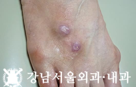 CASE 31 61세 여성 결절종
