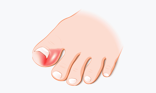 내향성 조모증이 생긴 엄지발가락 일러스트