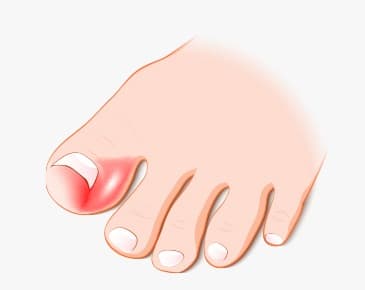 내향성 조모증 이미지