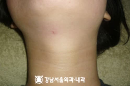 임파낭종 흡인 후 목 부위