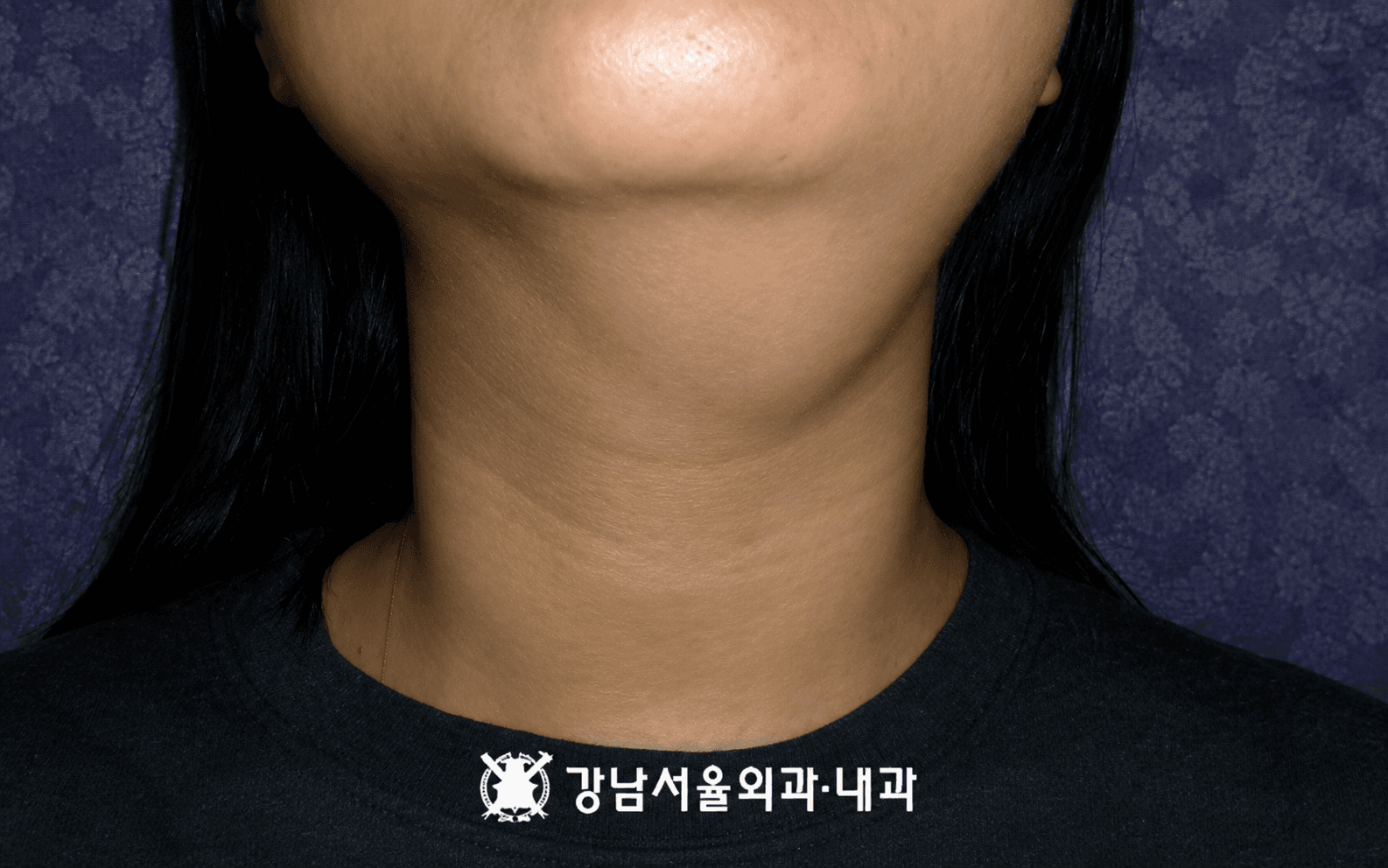 임파낭종 흡인 전 목 부위