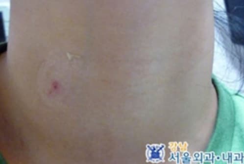 갑상선 고주파절제술 치료 후 목 부위