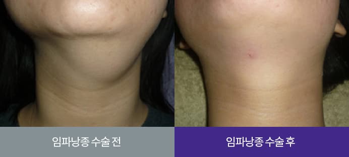 임파낭종 수술 전과 수술 후 목 부위