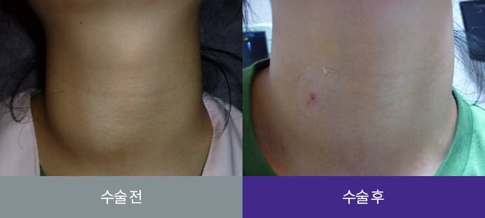갑상선 종양 수술 전과 수술 후 목 부위