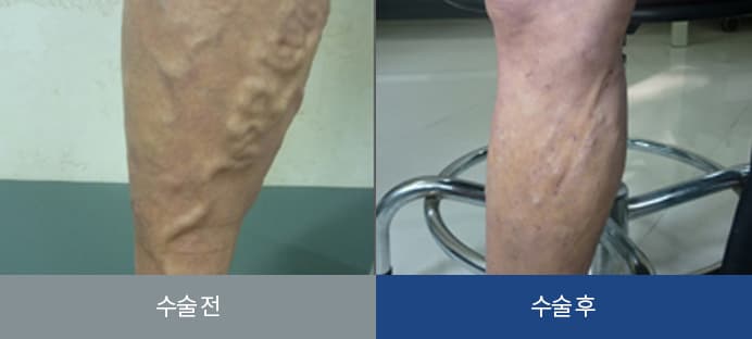 하지정맥류 치료 전후 비교 1