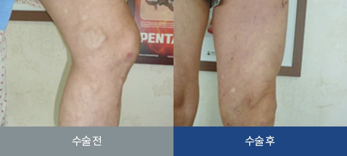 하지정맥류 치료 전후 비교 2
