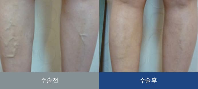 하지정맥류 치료 전후 비교 3