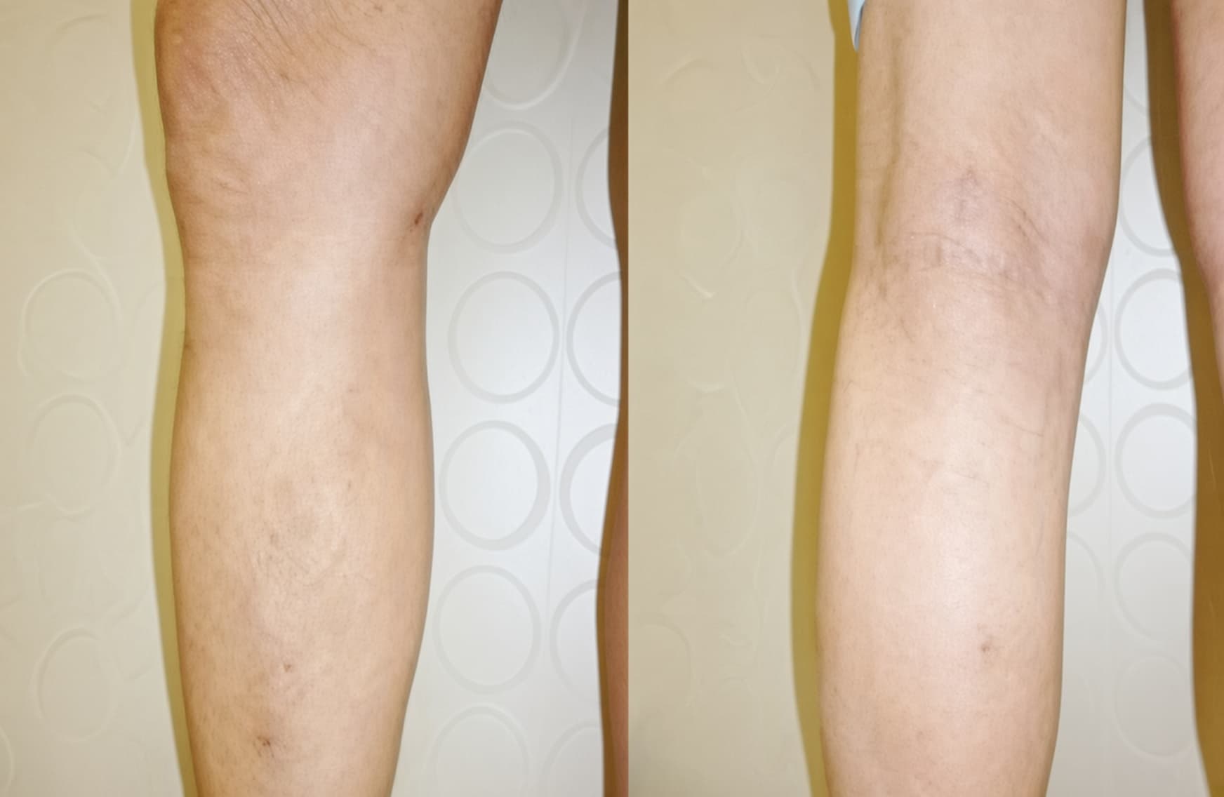 하지정맥류 정맥발거술 수술 전후 비교 1 수술 후