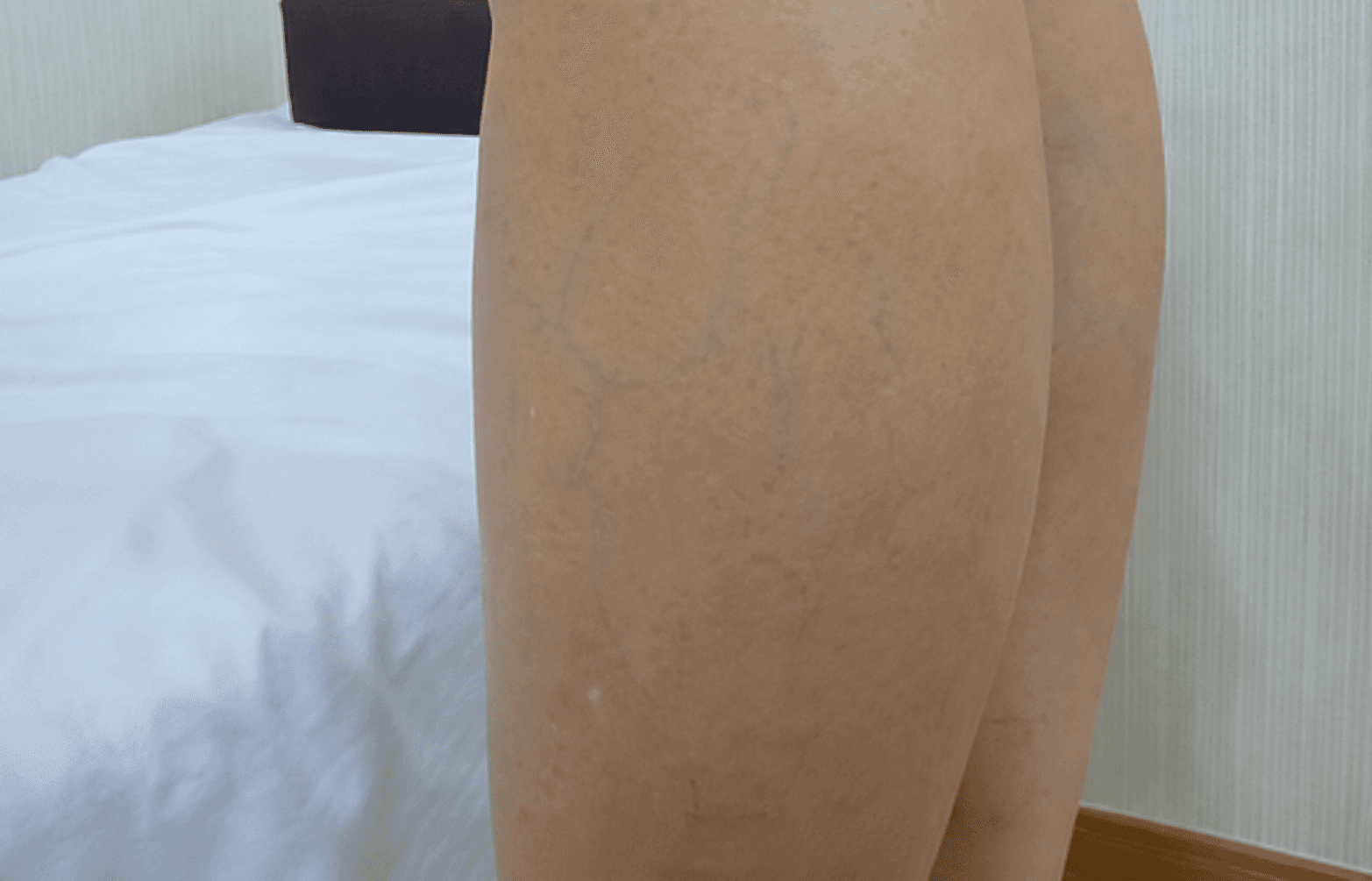 하지정맥류 정맥발거술 수술 전후 비교 4 수술 후