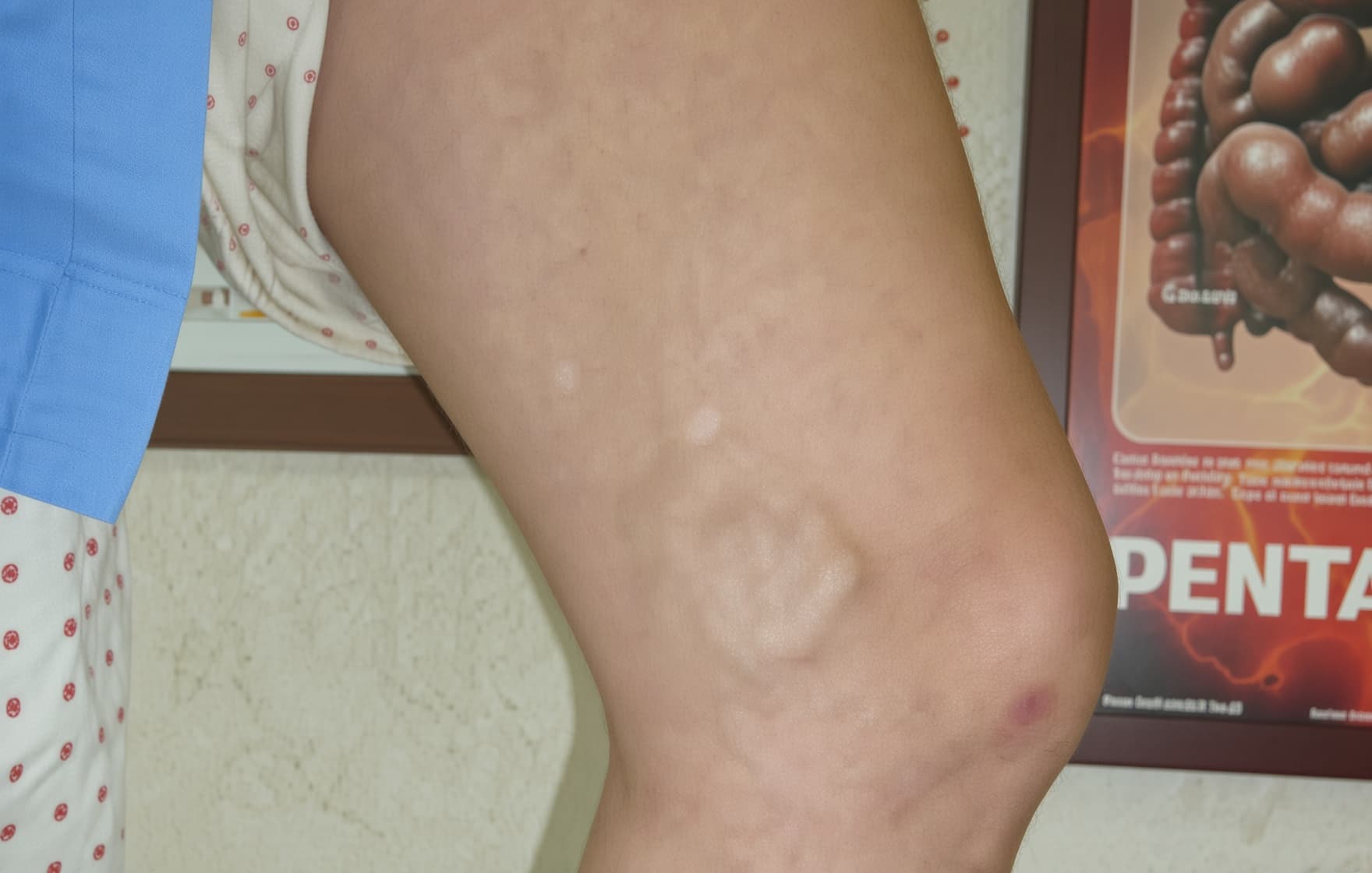 하지정맥류 정맥발거술 수술 전후 비교 2 수술 전