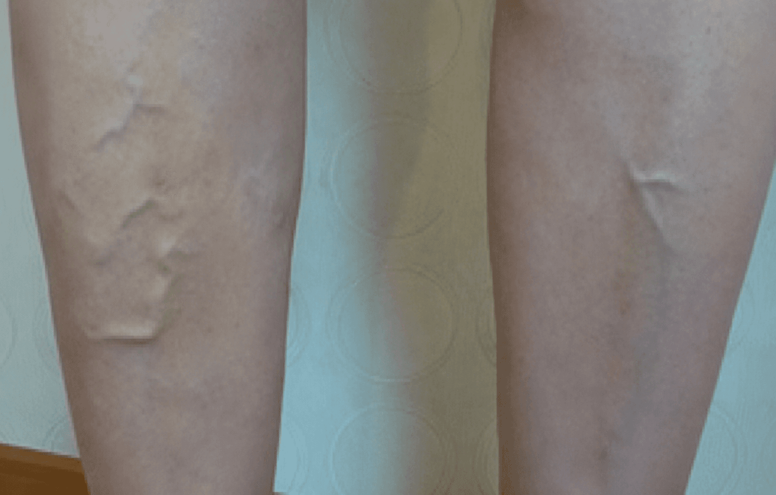 하지정맥류 정맥발거술 수술 전후 비교 5 수술 전