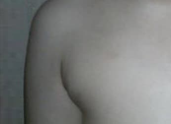 부유방 수술 후 겨드랑이 부위