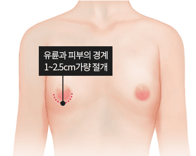 여유증 수술 시 유륜 경계 절개 위치를 표시한 일러스트