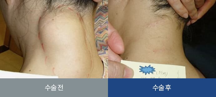 지방종 수술 전과 수술 후 목 부위