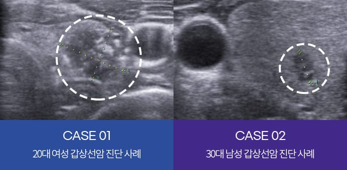 CASE 01 20대 여성 갑상선암 진단 사례, CASE 02 30대 남성 갑상선암 진단 사례
