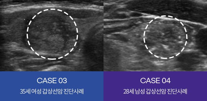 CASE 03 35세 여성 갑상선암 진단 사례, CASE 04 28세 남성 갑상선암 진단 사례