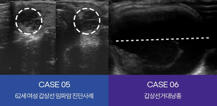 CASE 05 62세 여성 갑상선암 임파암 진단 사례, CASE 06 갑상선거대낭종